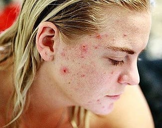 woman with acne skin